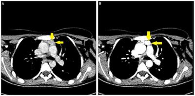 Case report: a rare case of primary hyperparathyroidism due to an intrathymic ectopic parathyroid adenoma incidentally diagnosed in a 15-year-old girl